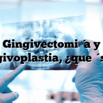 Gingivectomía y gingivoplastia, ¿qué son?